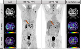 美国看病：Ga-68 FAPI PET 可改善胰腺癌检测和分期