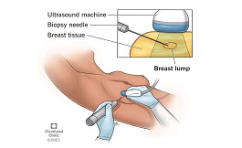 安德森癌症中心：一文了解乳腺活检